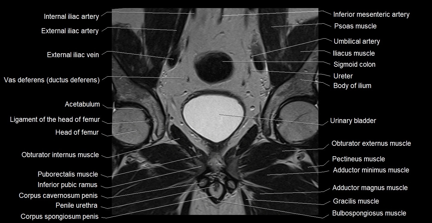 MRI coronal cross sectional anatomy male pelvis image 17.webp